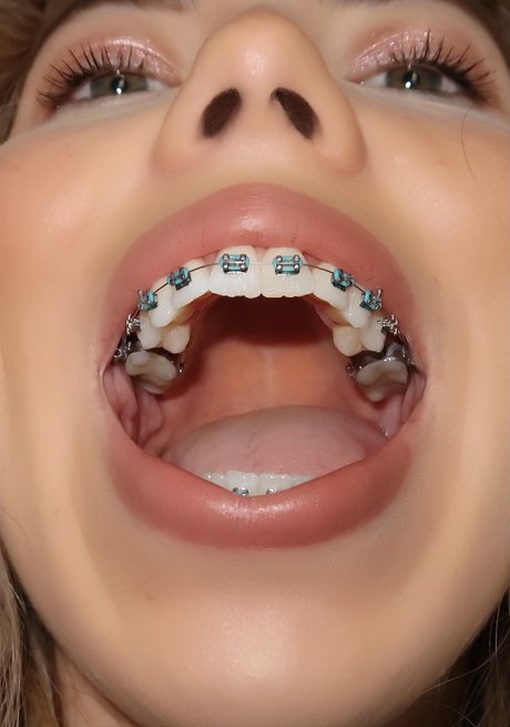 Kate In Braces